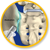 Sacroiliac Joint Pain  Novus Spine & Pain Clinic, Lakeland, Florida